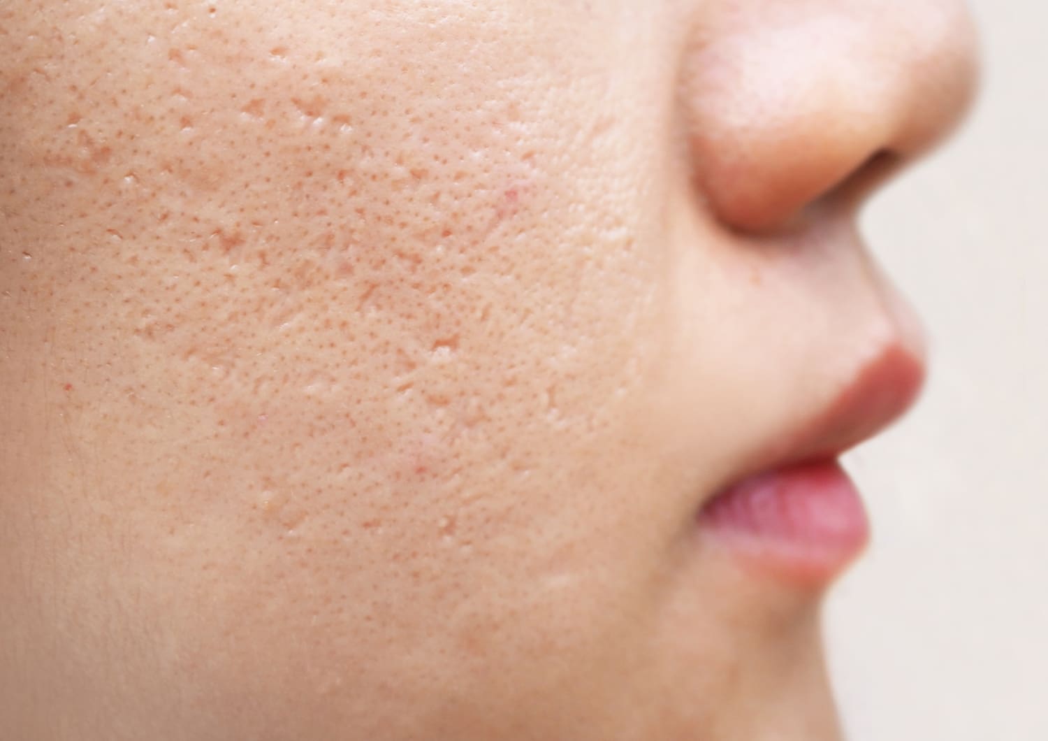 Acne scarring — NeoGen at Woodside Skin Clinic