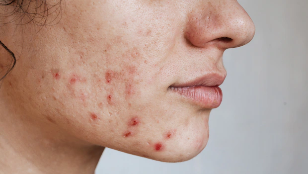 Acne — NeoGen at Woodside Skin Clinic