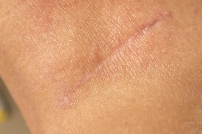Body scars — NeoGen at Woodside Skin Clinic