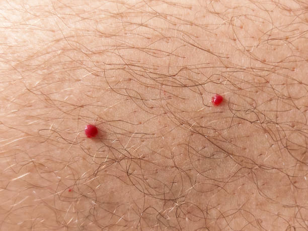 Cherry Angiomas — Woodside Skin Clinic