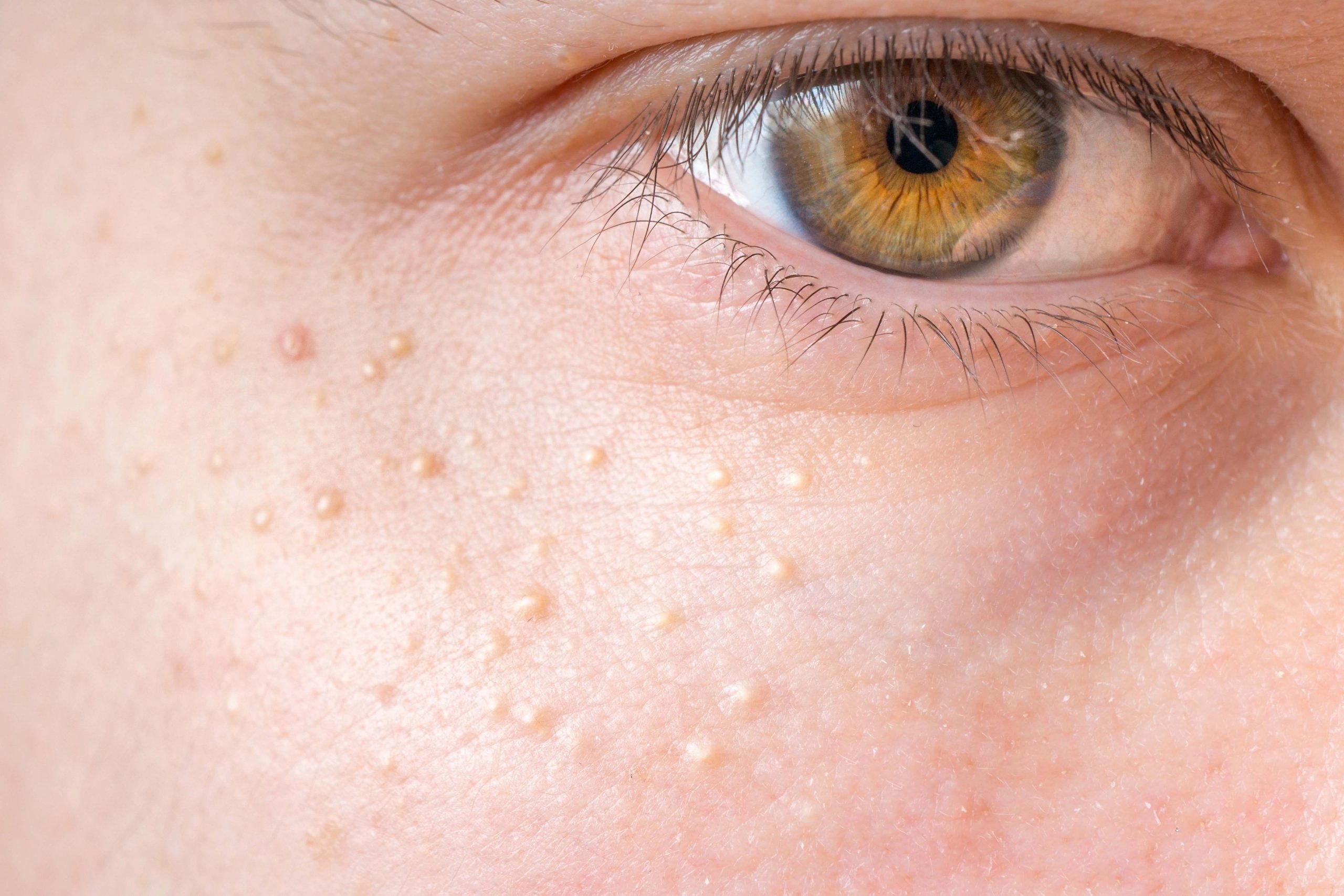 Milia — Woodside Skin Clinic
