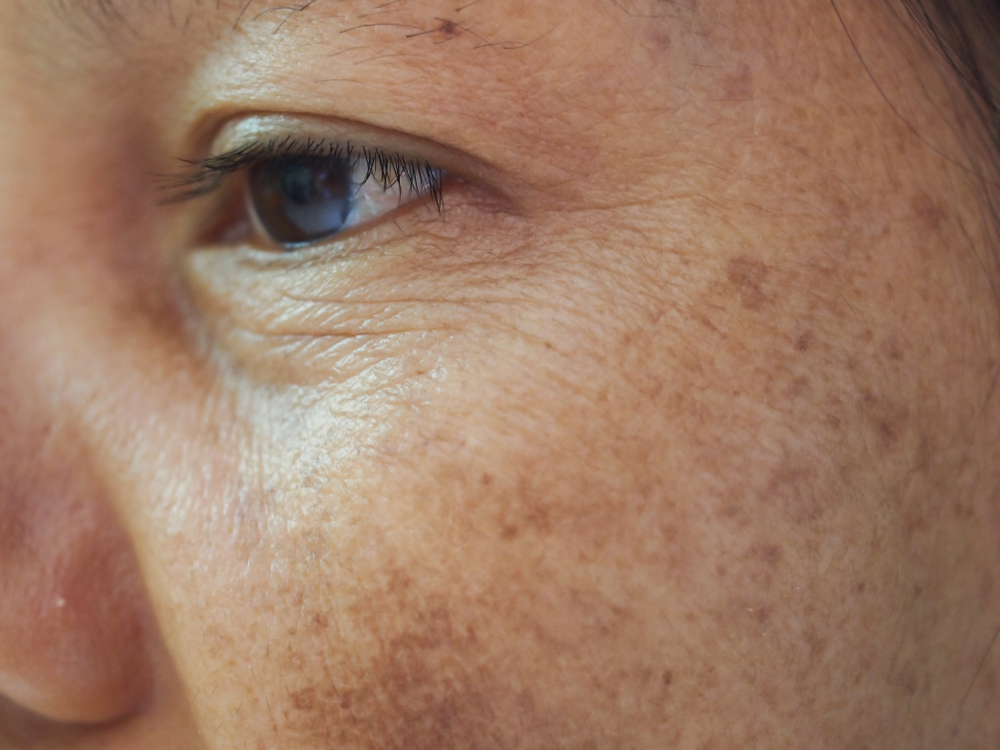 Pigmentation — NeoGen at Woodside Skin Clinic