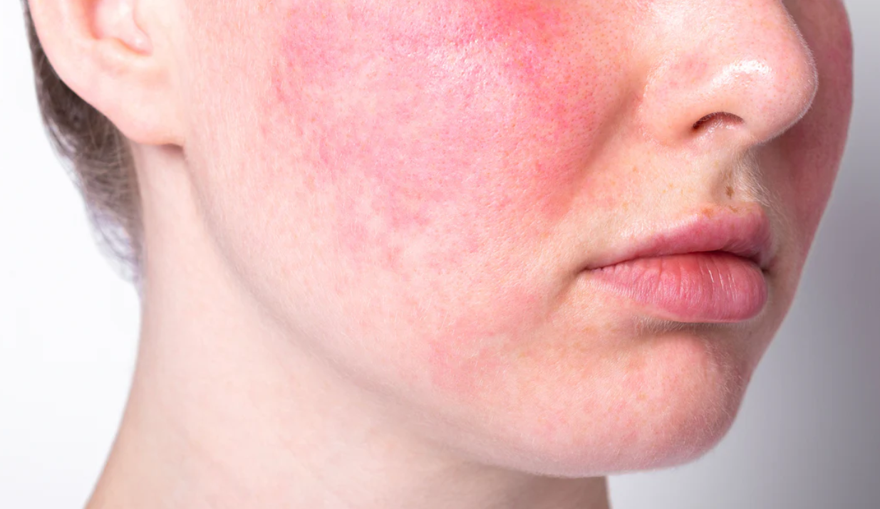 Rosacea — NeoGen at Woodside Skin Clinic