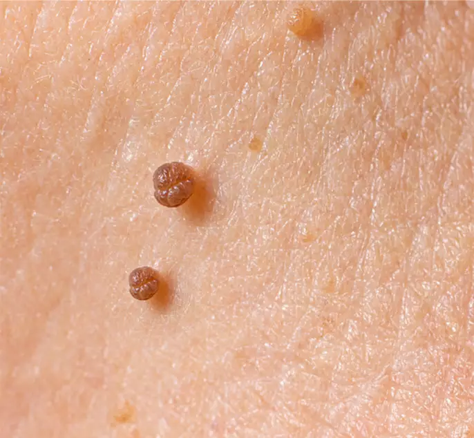 Skin Tags — Woodside Skin Clinic