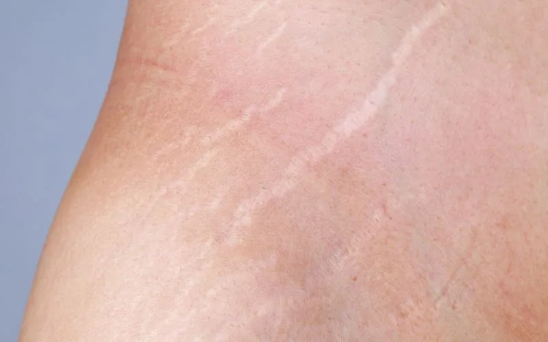 Stretch Marks — Woodside Skin Clinic