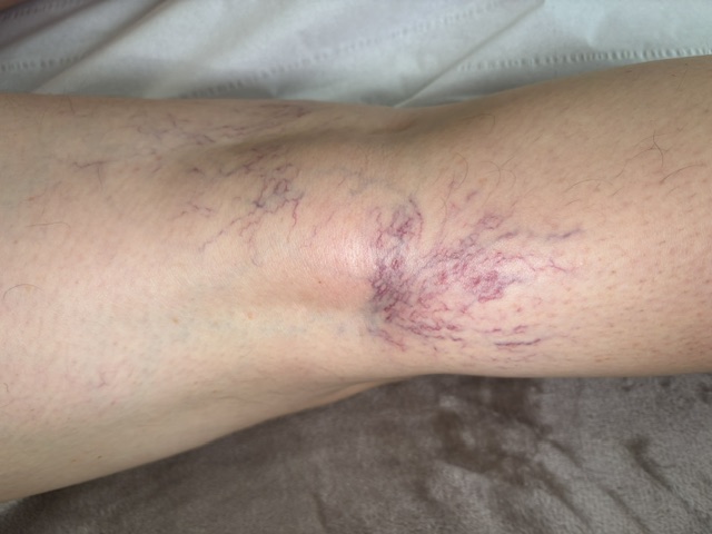 Thread Veins — Woodside Skin Clinic