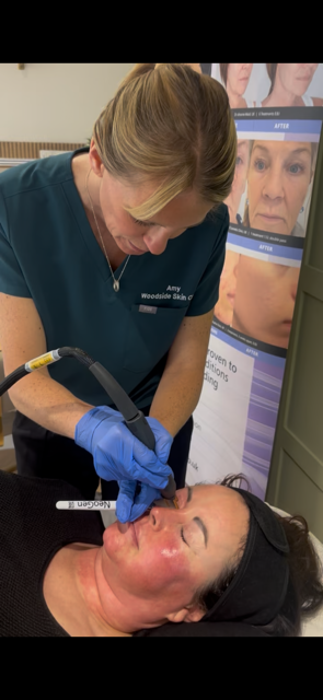 NeoGen plasma treatment in progress at Woodside Skin Clinic